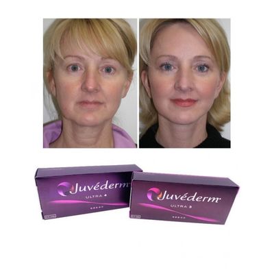 6-9 महीने की अवधि Juvederm Dermal Filler Gel ऑनलाइन और स्टोर में खरीद के लिए
