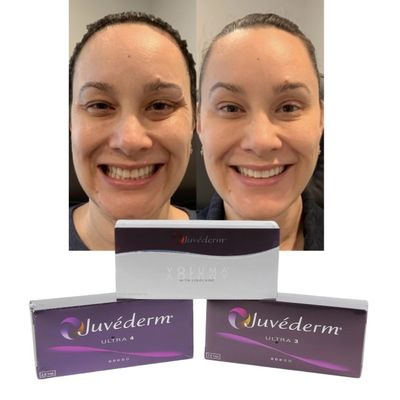Juvederm Dermal Lip Fillers Hyaluronic Acid क्रॉस लिंक्ड इंजेक्शन