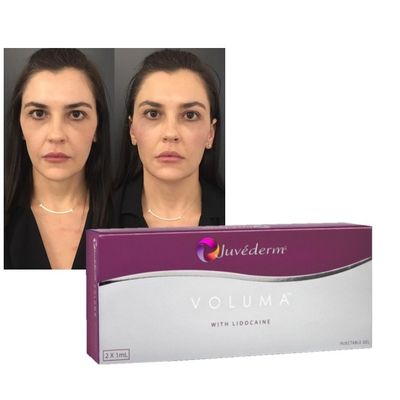 Juvederm Dermal Lip Fillers Hyaluronic Acid क्रॉस लिंक्ड इंजेक्शन