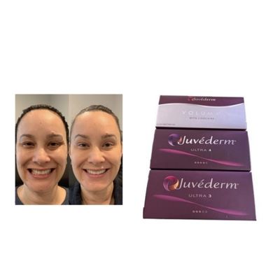 क्रॉस-लिंक्ड HA Juvederm Dermal Filler Ultra3 Ultra4 Volume भंडारण की शर्तें चेहरे की मात्रा बहाल करने के लिए फ्रीजिंग से बचें इंजेक्शन योग्य जेल